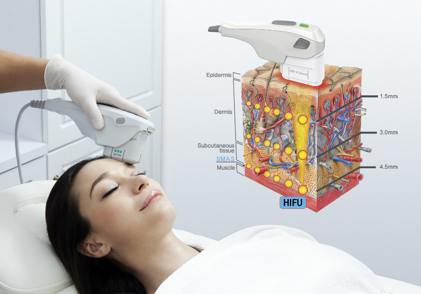HIFU Facelift