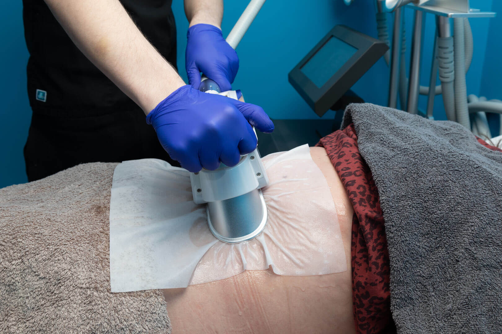 Fat Freezing Treatment Newcastle