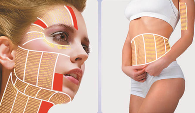 HIFU Rejuvenation &#8211; Tightening of the Body