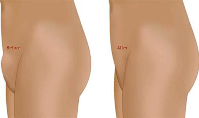 Can Fat Freezing be used on the pubic area