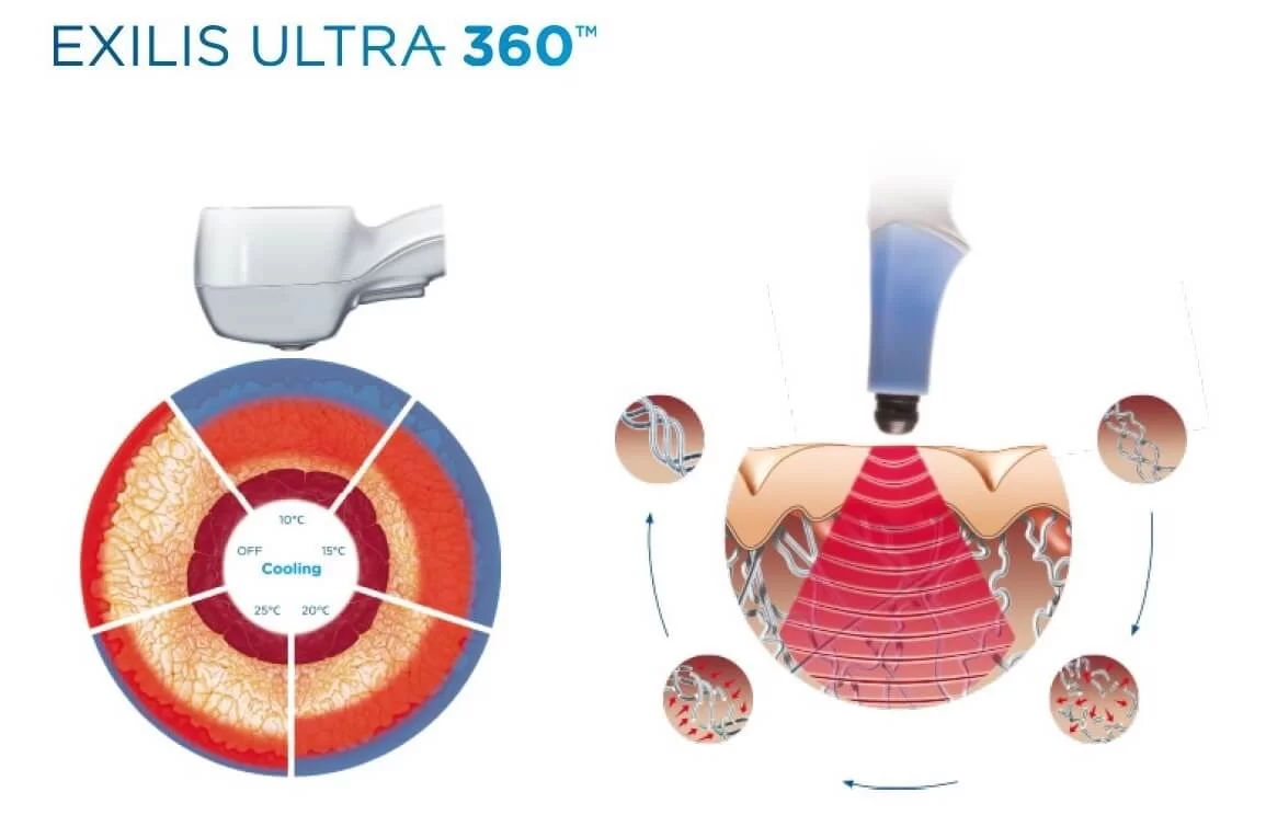 EXILIS VS HIFU