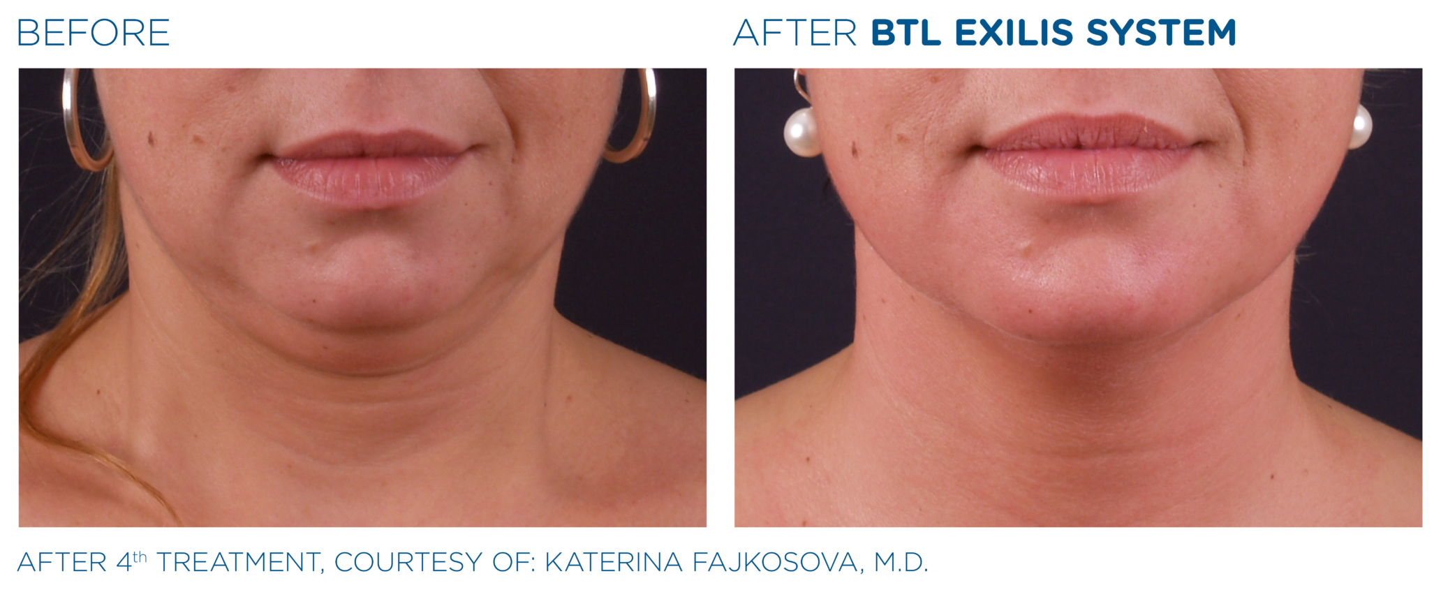 Before and After Photos of BTL Exilis Face