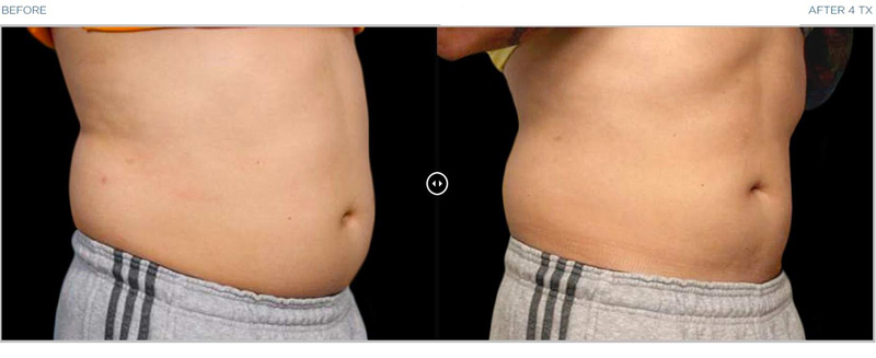 fat removal and muscle growth treatement