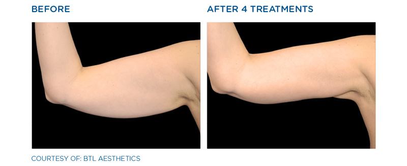 Fat removal and sskin tightening on arms