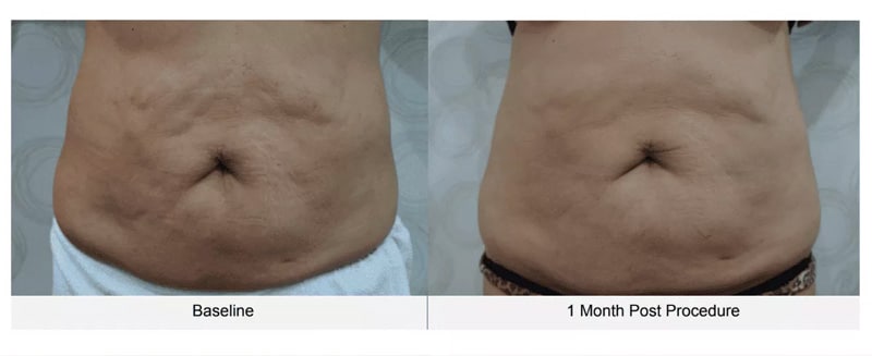 fat removal before and after