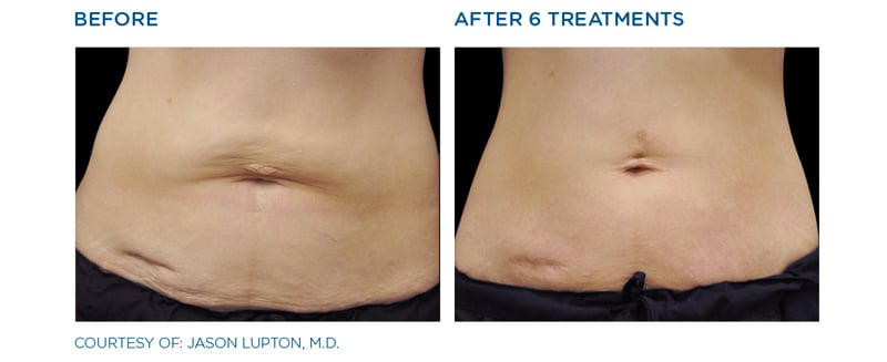 Skin Tightening on stomach