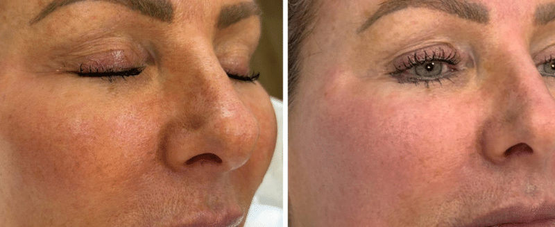 Bio Spicule Bio-Microneedling