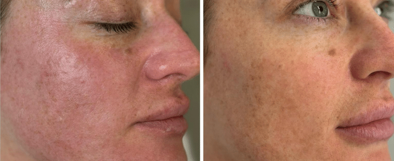 Bio Spicule Bio-Microneedling image 6