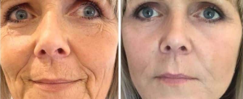 Before and After Exilis face