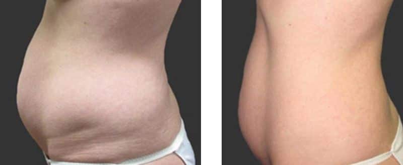 BTL Exilis Body Newcastle - Before and After photo