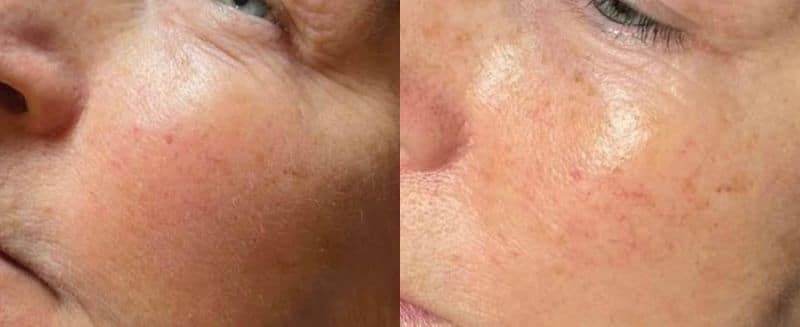 LED Light Therapy before and after photo 1