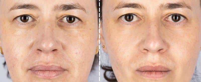 LED Light treatment Newcastle Upon Tyne