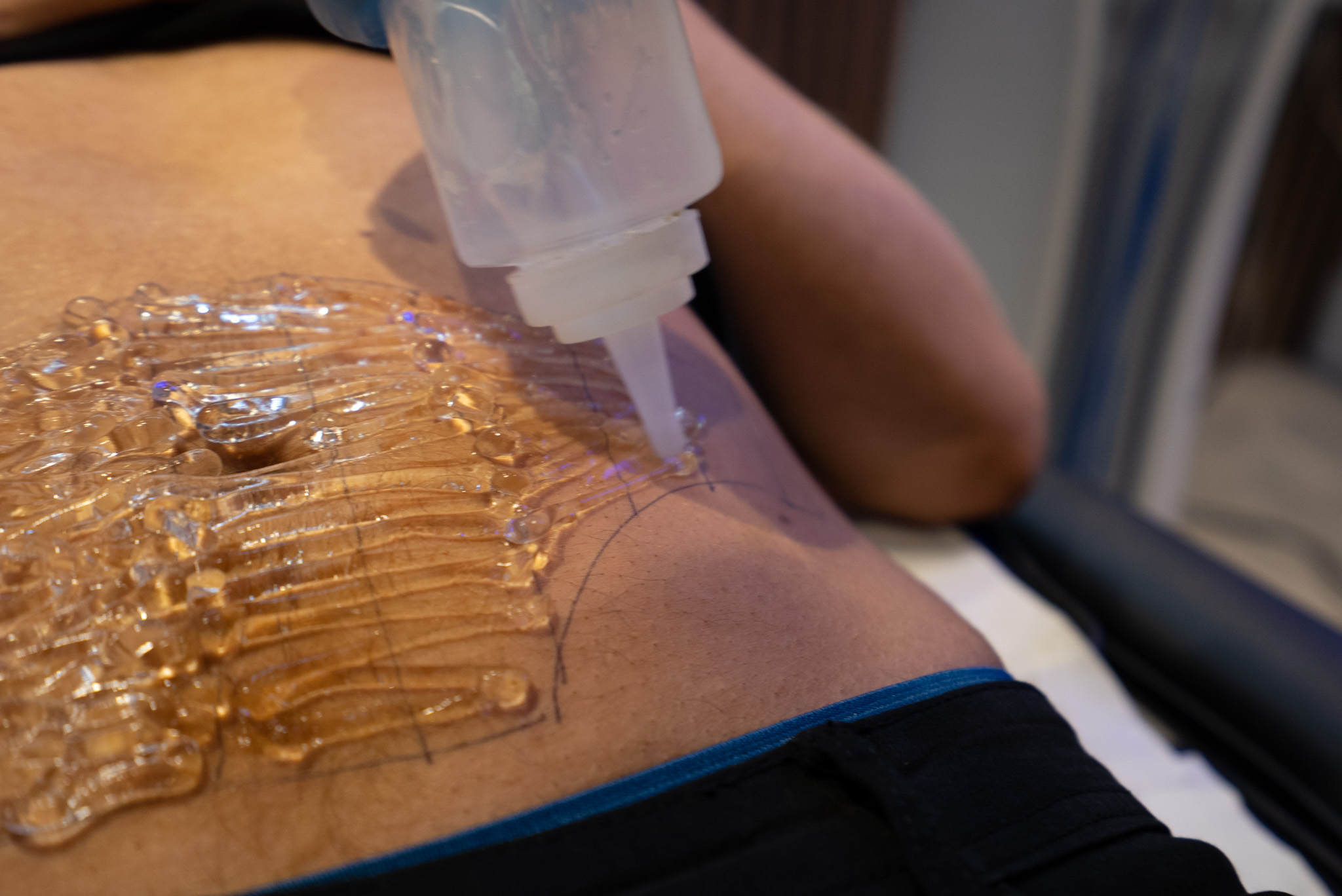 HIFU ULTRAcel Q+ Body